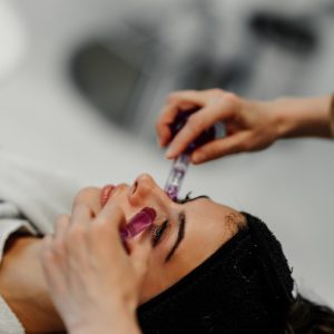 microneedling with prp