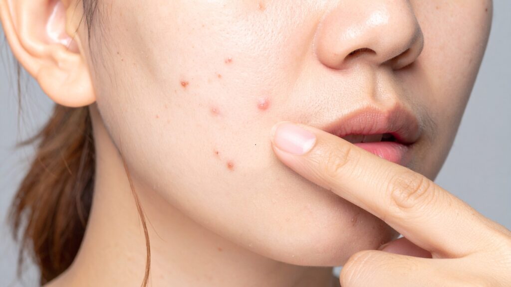 adult acne treatments