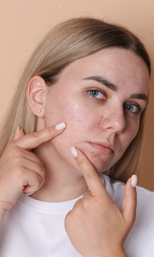 adult acne treatments Lakewood colorado