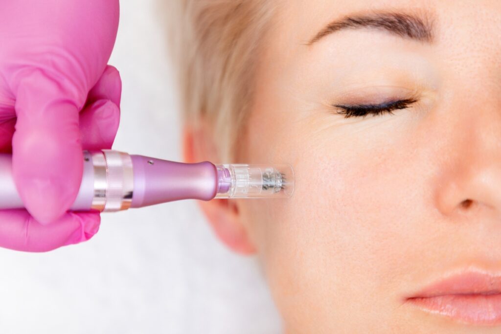 microneedling lakewood